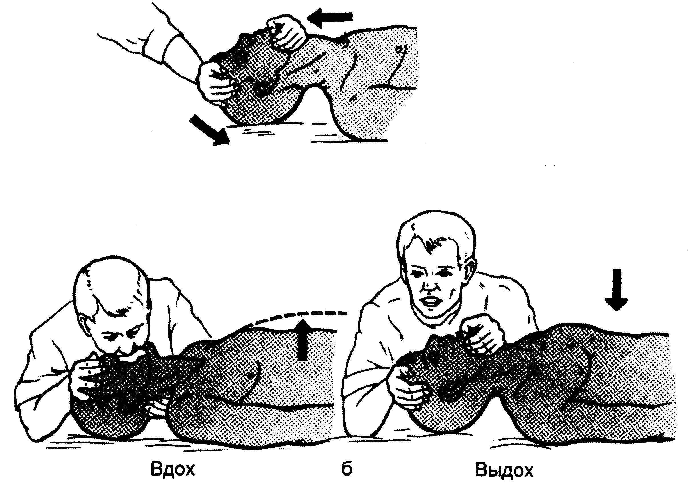 Искусственное дыхание Сердечно-легочная реанимация